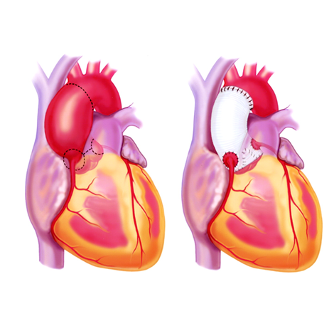 advanced-aortic-surgery