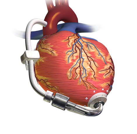 heart-failure-surgeries