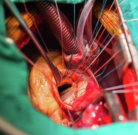 minimally-invasive-valve-surgeries