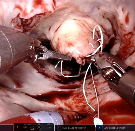 redo-complex-valve-surgery